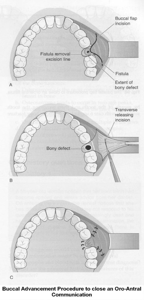 Closure Of Mouth Sinus Holes Exodontia