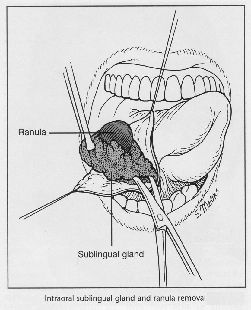 Sublingual Gland Removal Exodontia