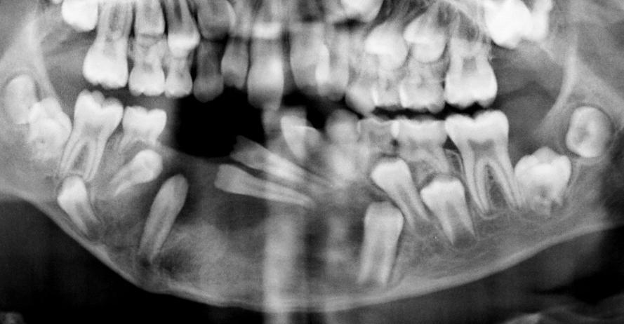Radiograph of the above patient, 1 year post-op