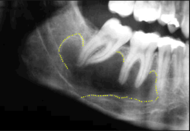 Aneurysmal Bone Cyst Exodontia 3497