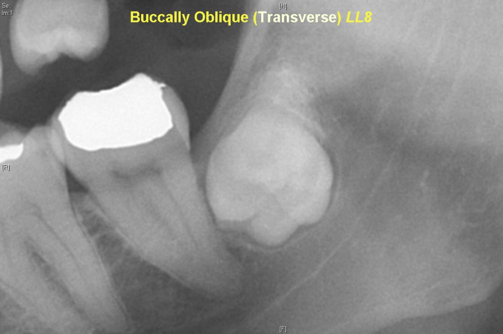 Buccal_Obliquity_of_LL8_crown_pointing_towards_cheek_-1005x668