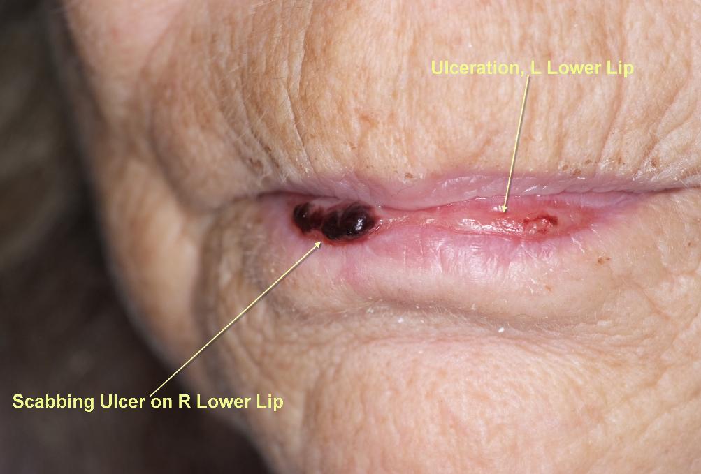 Chronic_Ulcerative_Stomatitis_-_scabbing_ulcers_R_lower_lip_ulcers_L_lower_lip-1003x679