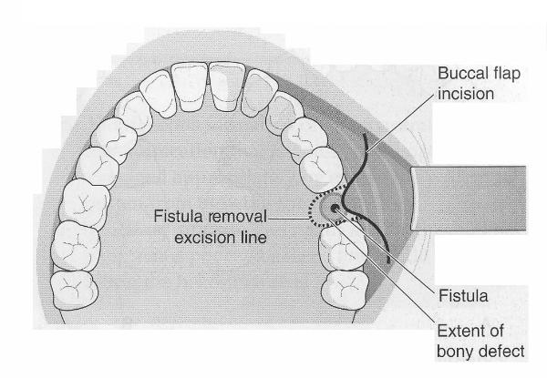 Diagram_of_Buccal_Advancement_Flapused_to_close_an_OAC_1-600x415