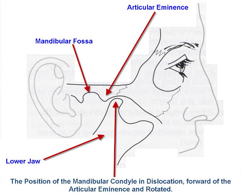Dislocated_Mandible_-_Position_of_Condyle-770x623