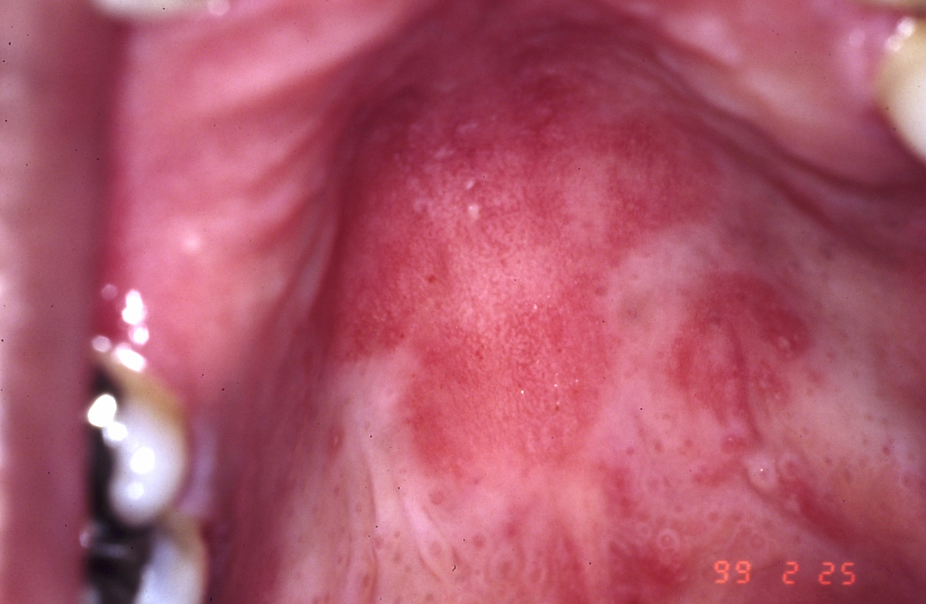Photo of Acute Atrophic Oral Candidiasis / Erythematous Candidiasis
(Antibiotic / Steroid-Induced Stomatitis)