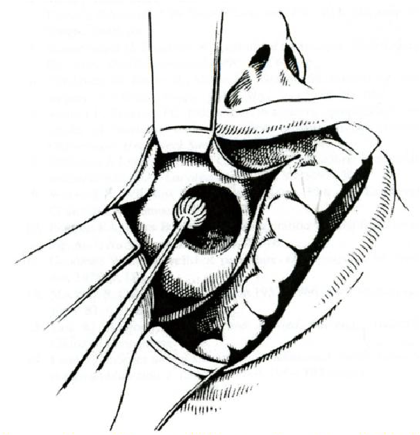 Diagram showing the surgical technique where a long sub-labial incision facilitates gentle tissue retraction and the anterior antrostomy is created by a cutting burr.