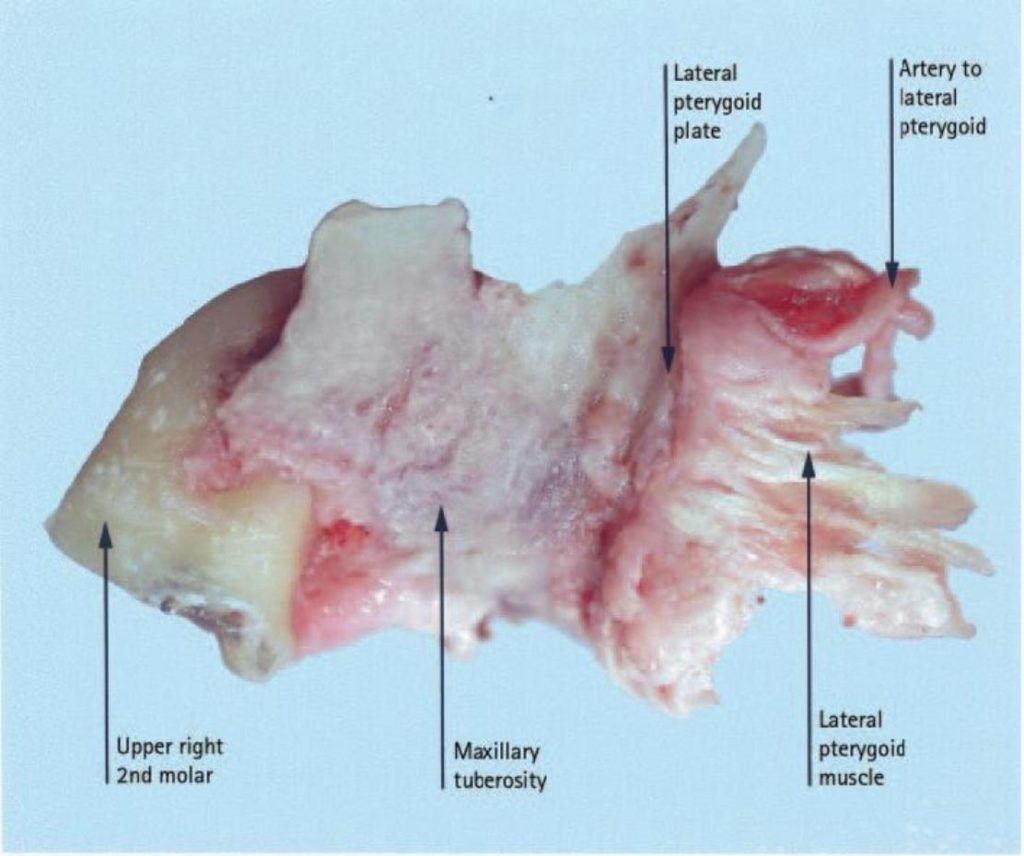 Fractured Maxillary Tuberosity Exodontia