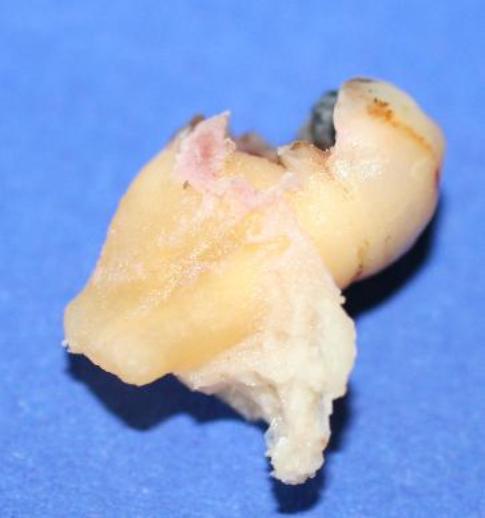 Extracted Upper Molars with Larger Piece of Adherent Tuberosity
"Moderate / Medium Tuberosity Fracture"