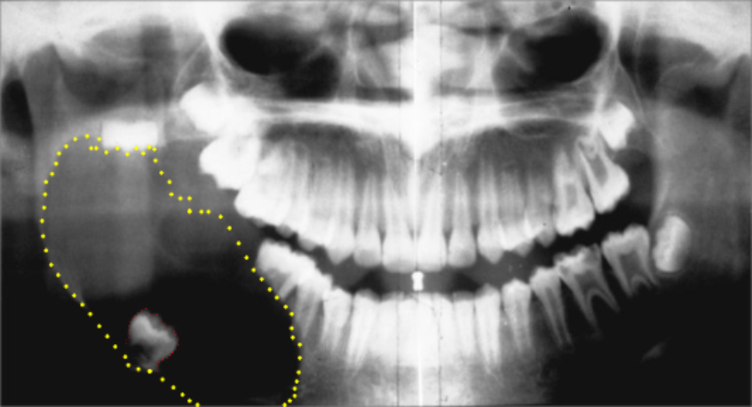 Jaw_Xray_showing_a_very_large_dentigerous_cyst_yellow_dots_tooth_red_dots_on_the_patient_s_lower_right_jaw-533x279-847x459