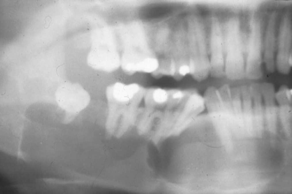 Jaw_Xray_showing_an_odontogenic_keratocyst_areas_of_darkness_in_the_lower_jaw_-533x344-1015x673