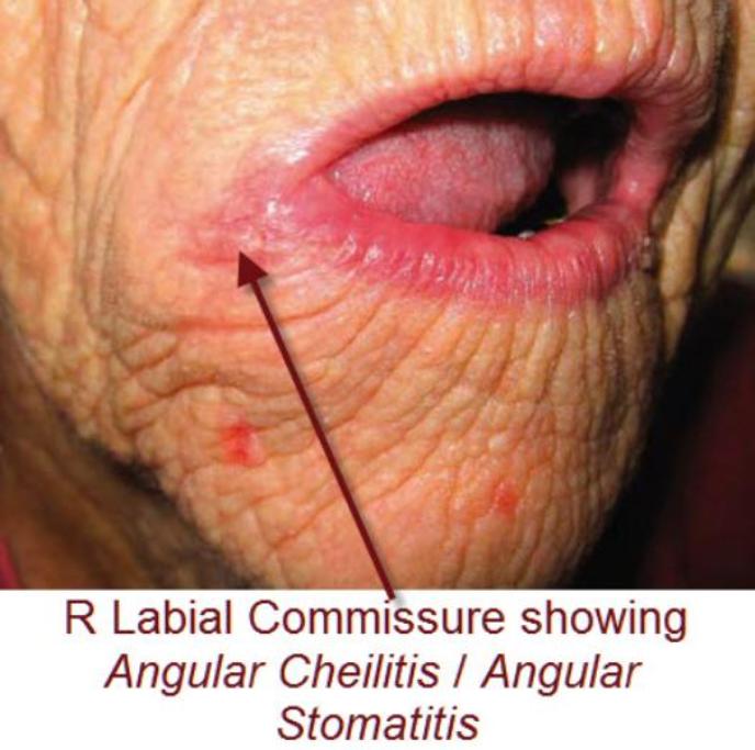 Labial_Commissure_-_Angular_Stomatitis2-525x522-688x683