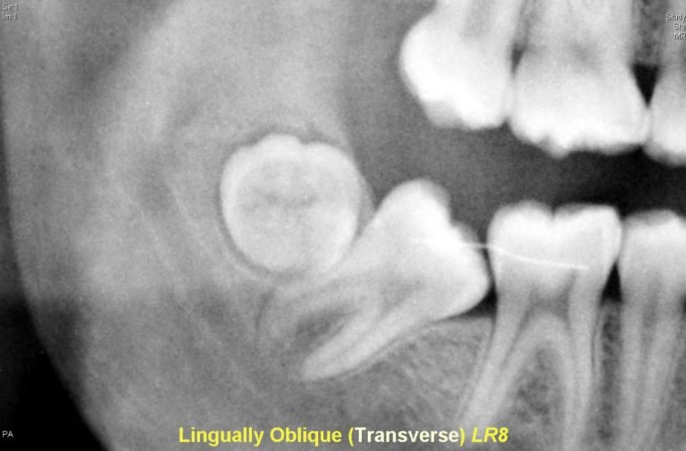 Impaction Classification – Exodontia