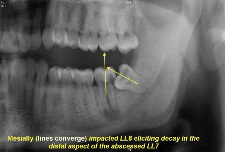 Impaction Classification Exodontia