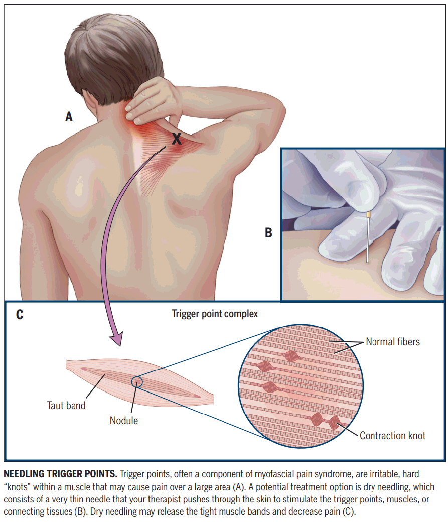 Acupuncture for Trapezius Trigger Points — Morningside Acupuncture NYC