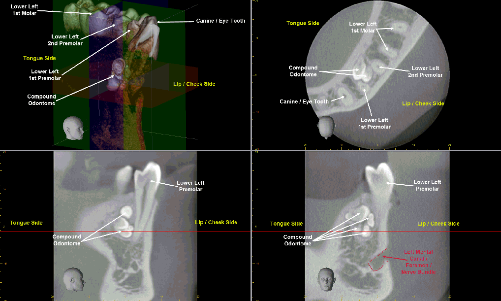 Odontome_Annotated_CBCT2-1018x611