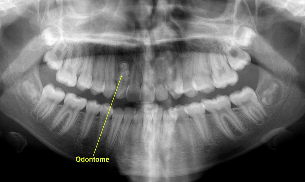 Odontome_Upper_Right_Lateral_Incisor-1015x607