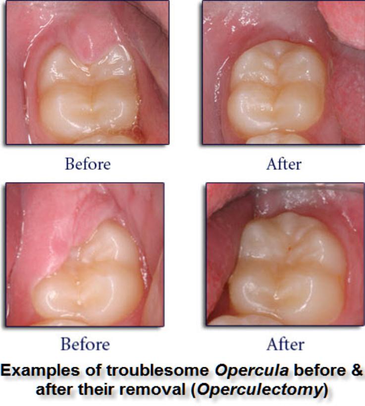 Photo of Pericoronits / Operculitis effecting Lower Jaw Wisdom Teeth
