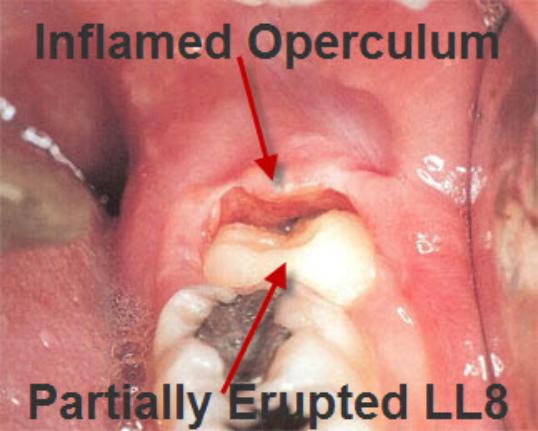 wisdom teeth stitches fall out