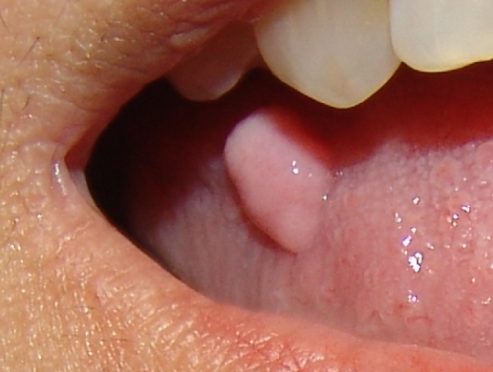 Oral_Fibroma_or_Fibro-Epithelial_Polyp_of_the_right_side_of_the_tongue-532x396-1009x762