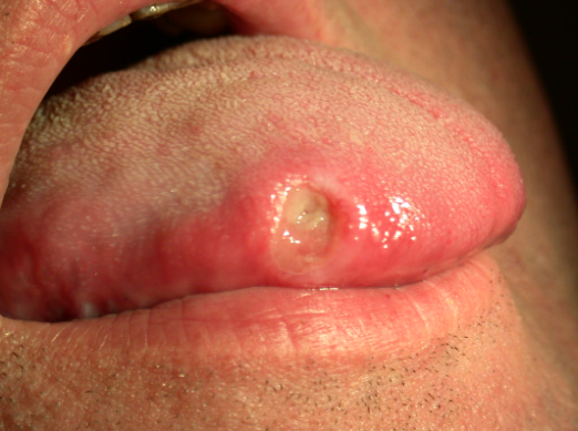 Oral_Ulcer_or_Aphtha_on_the_tongue-533x398-522x389