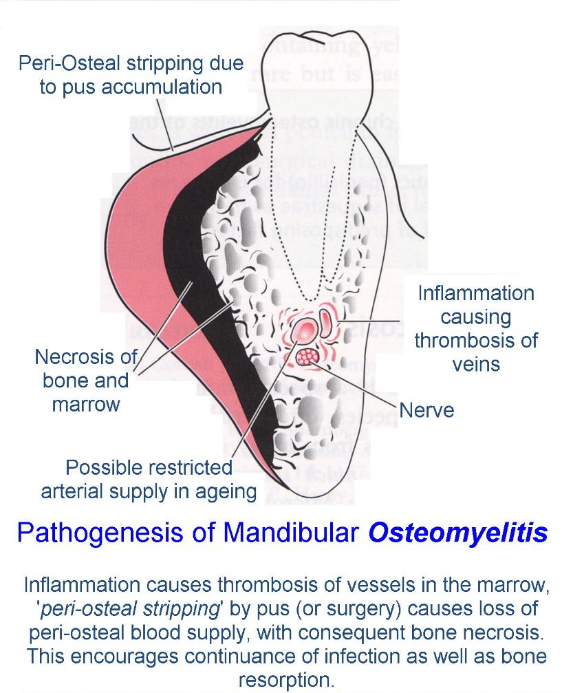 osteomyelitis jaw after wisdom teeth extraction