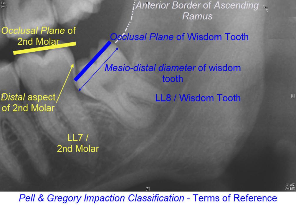 Pell_Gregory_Impaction_Classification_2-1005x698
