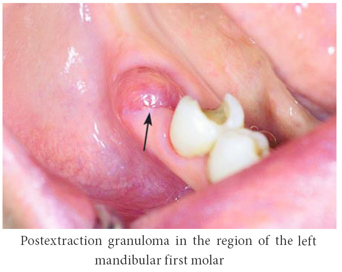 wisdom teeth holes infection