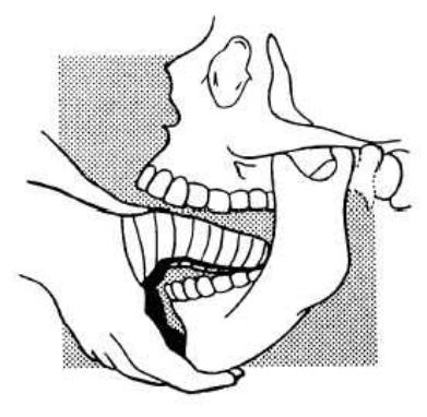 Relocation of the subluxed TMJ - note, gauze wrapped around
the thumbs
