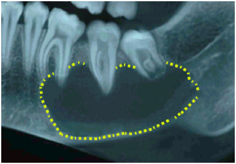 Solitary Bone Cyst Exodontia 1015