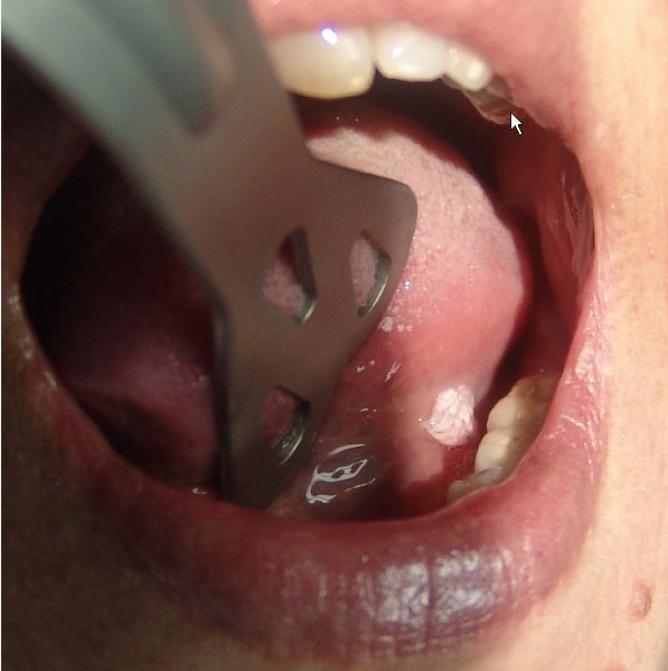 Squamous cell papilloma mouth, Squamous papilloma in the mouth, Squamous papilloma back of tongue