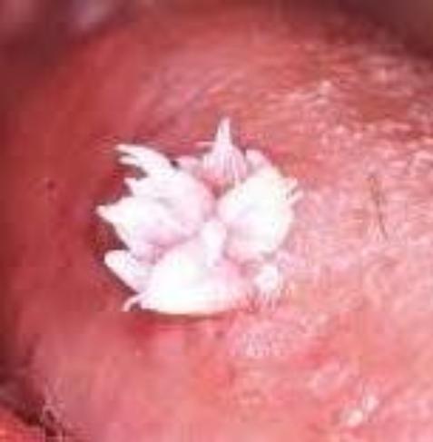 Removing papilloma from tongue