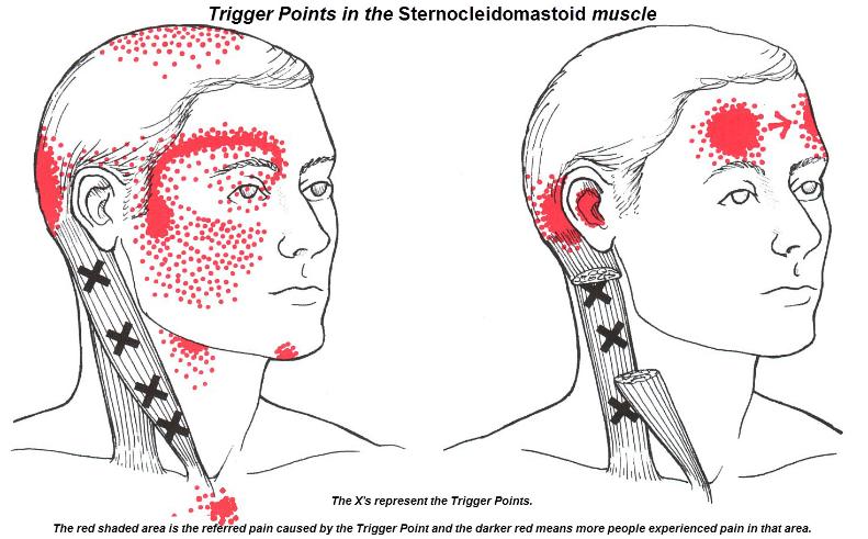 Sternocleidomastoid-791x491 (1)