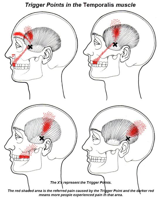 Acupuncture – Exodontia