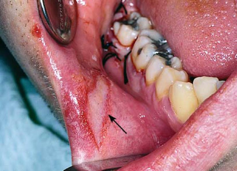 Abrasion of the lower lip as a result of contact with the removal of an impacted lower 3rd molar