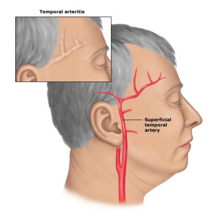 Diagram_Showing_Typical_Site_for_Temporal_Arteritis-732x715