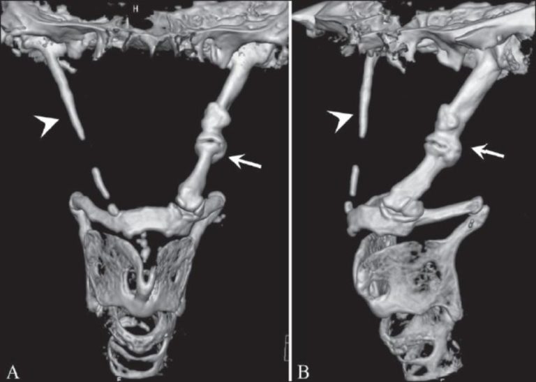 Eagle Syndrome Exodontia