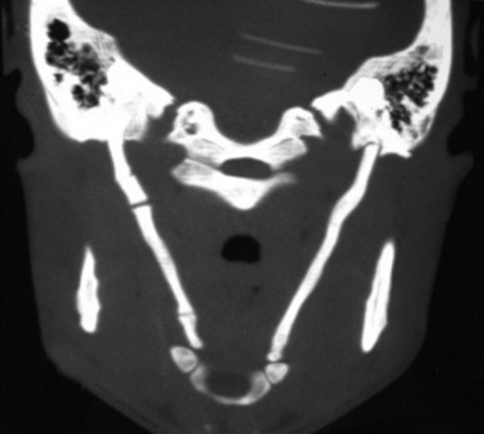 CT showing bilateral calcified styloid processes & ligaments (below)