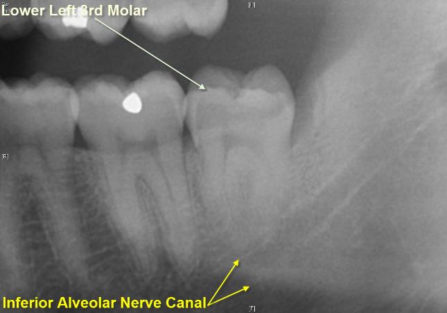 The X-Rays & Photos show a Lingual Plate Fracture associated with the Lower Left Wisdom Tooth.