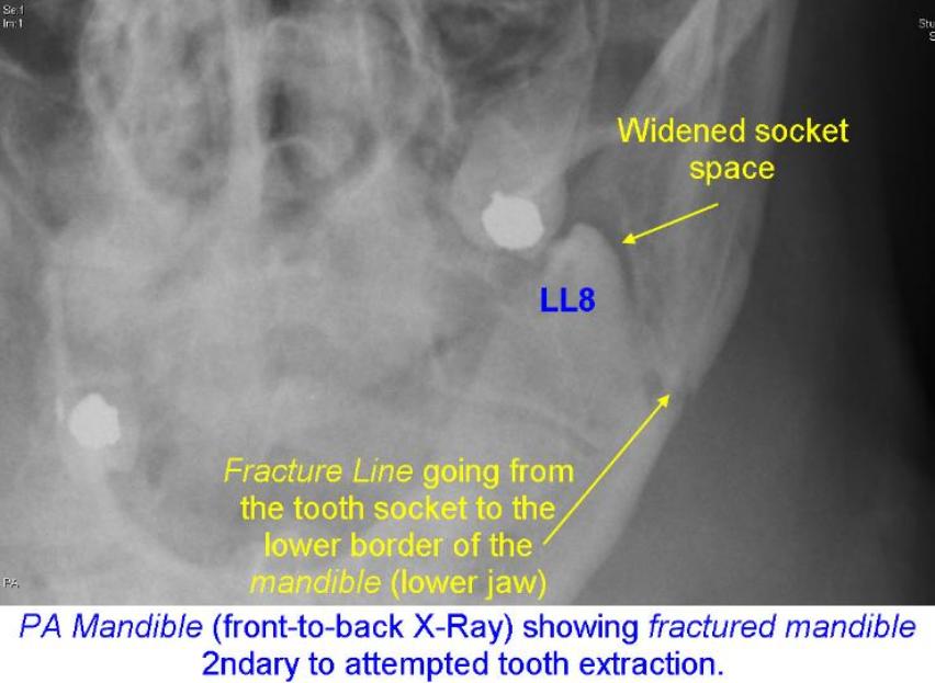 Post-op_L_Fractured_Mandible_removing_LL8_PA-739x539-852x623