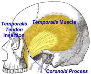 Temporalis Tendonitis – Exodontia