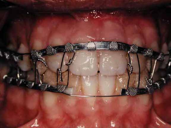 Application of the elastics from the screws to the mandibular teeth.