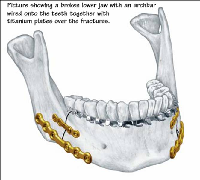 Fractures Of The Mandible Lower Jaw Exodontia