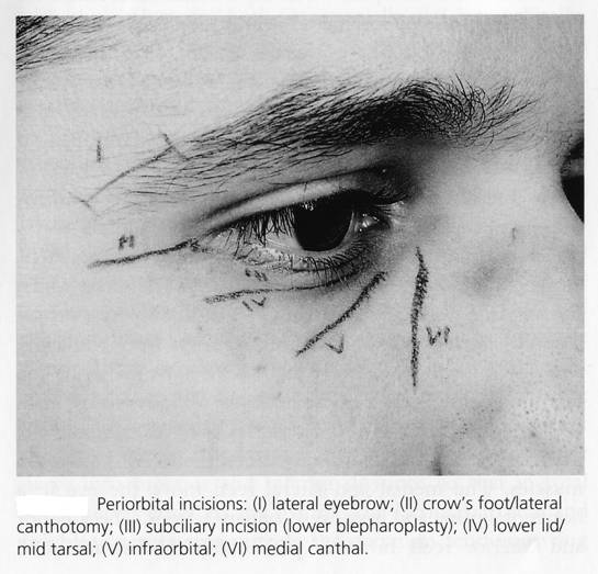 Incisions made to access fractures around the orbit & zygoma