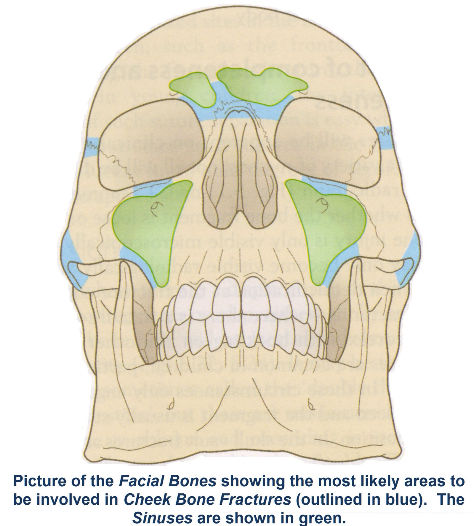 Fractures of the Cheek Bone / Zygomatic Complex – Exodontia