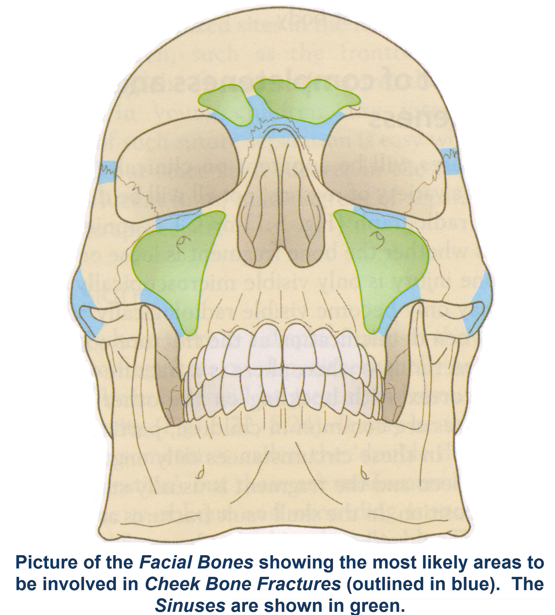 fractured cheekbone