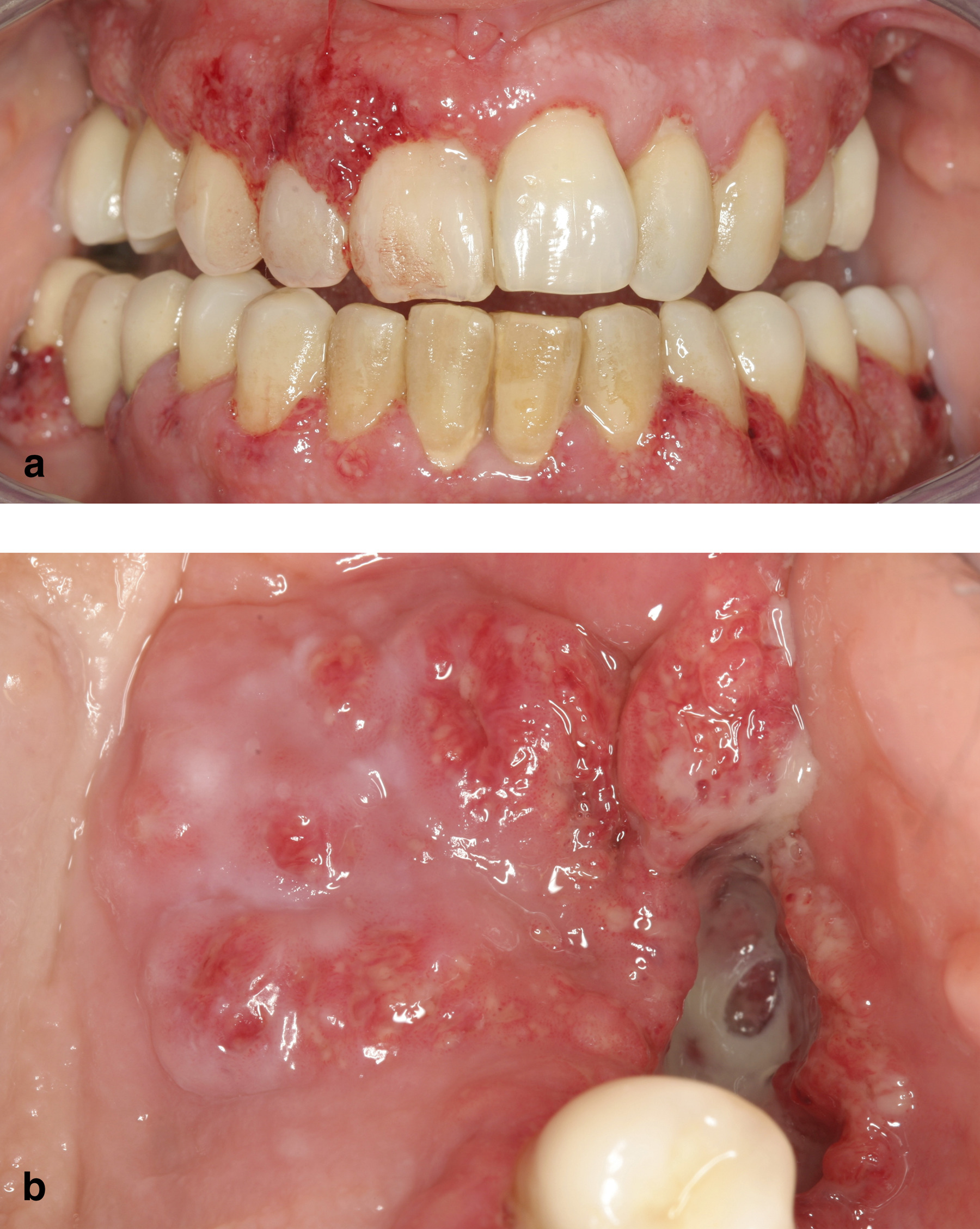 Oral-Wegeners-Granulomatosis-2