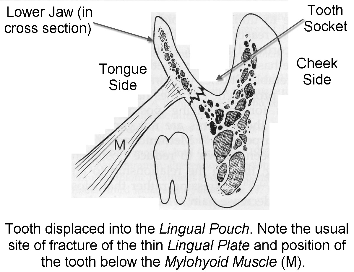 Tooth_Displacement_into_the_Lingual_Pouch